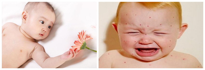 兒童濕疹反反復復，您有在家安裝家用除濕產品嗎？